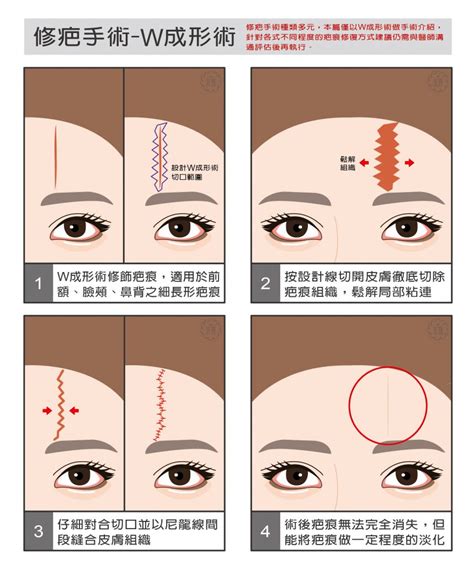 額頭傷疤|額頭疤痕手術說明 